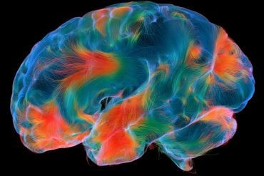 This shows a brian scan.