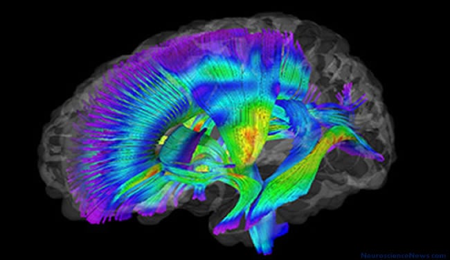 DTI brain scan is shown. A brain with tracts highlighted is seen.