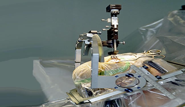 A deep brain stimulation electrode is inserted during a Parkinson's disease patient surgery.