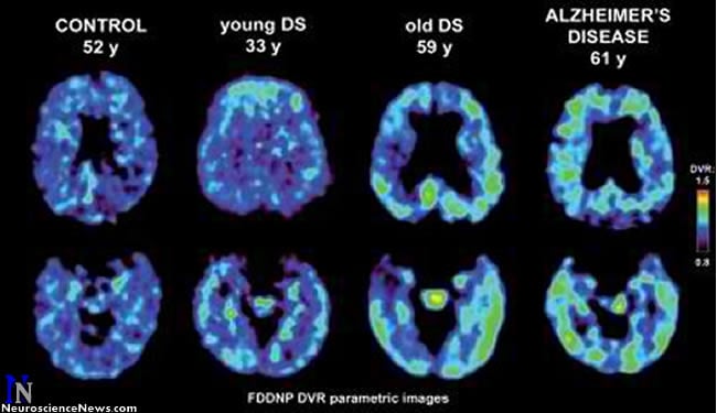 Image of brains in controls, young and old Down syndrome patients and Alzheimer's disease patients. 