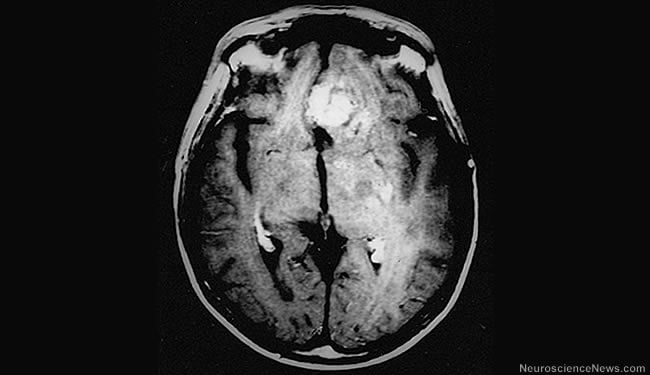 A brain scan shows glioblastomas.