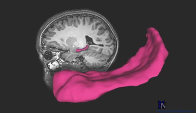 A brain with the hippocampus highlighted is shown.