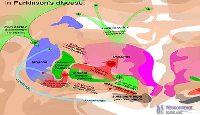 Parkinson's Disease Diagram - A Cause Possibly Discovered