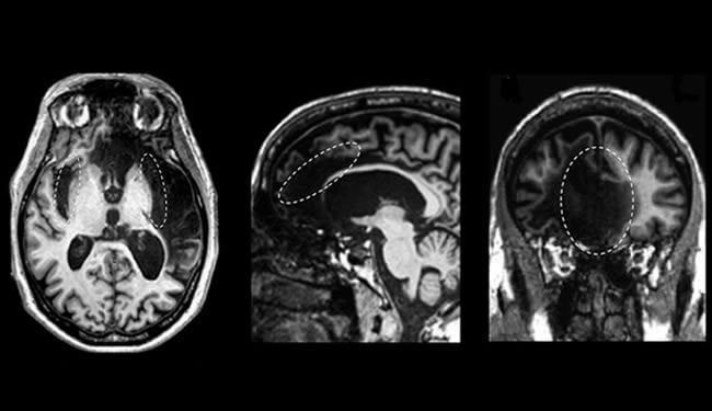 Three brain scans of Patient R are shown and described in the caption.