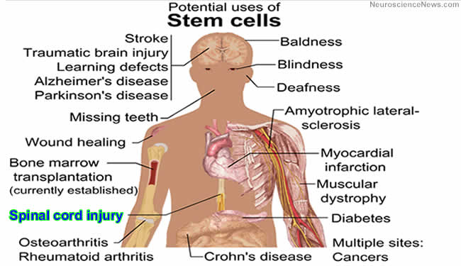Image of a human with sites labeled that could benefit from potential uses of stem cells.